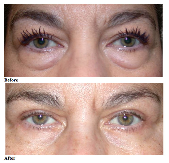 Blepharoplasty Eyelid Surgery Richmond, VA Minimal